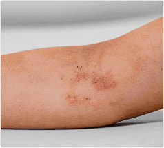 Atopowe zapalenie skóry